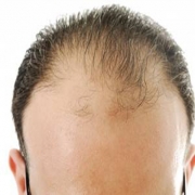 آیا ریزش مو ارثی میشود؟